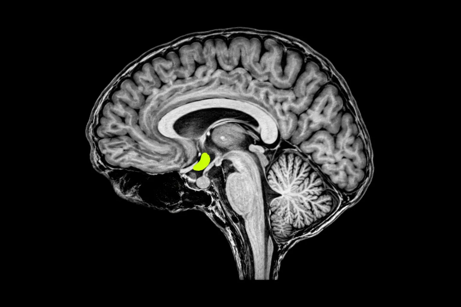 A white brain section on black with one small region lit yellow-green.